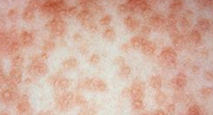 Image for Measles Alert for Brisbane and Springwood