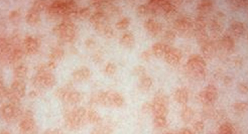 Close-up of a red, blotchy rash on skin, indicative of measles.