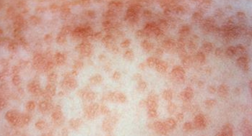 skin rash of a person infected with measles showing consistent bumps and inflamed skin 